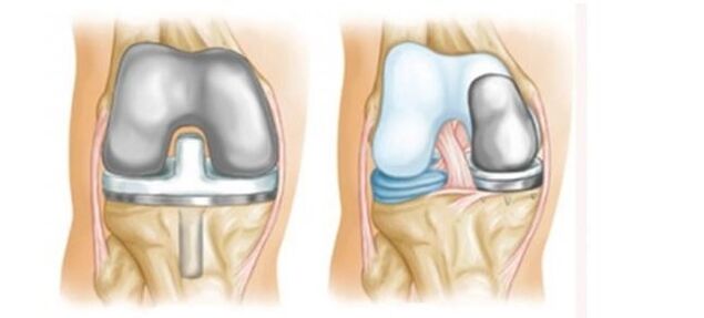 Endoprotesi per l'artrosi dell'articolazione del ginocchio