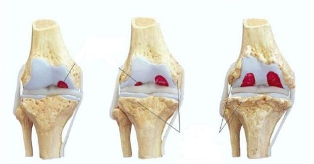 Fasi dell'osteoartrosi dell'articolazione del ginocchio