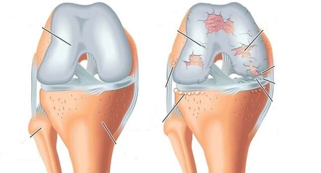 articolazione sana e artrosi dell'articolazione del ginocchio