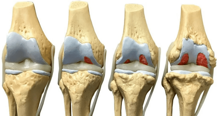 Danni all'articolazione del ginocchio in varie fasi dello sviluppo dell'osteoartrosi