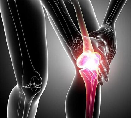 Danni all'articolazione del ginocchio da artrite e artrosi