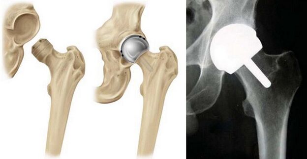 Artroplastica dell'anca
