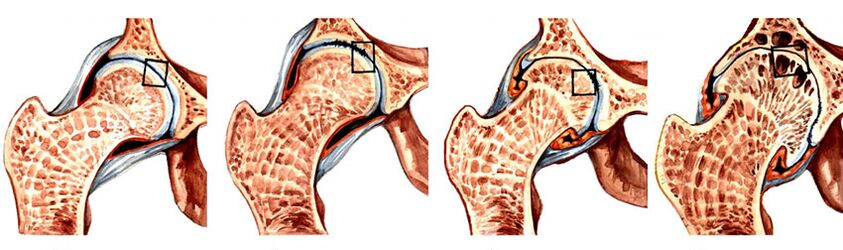 Il grado di sviluppo dell'osteoartrite dell'articolazione dell'anca