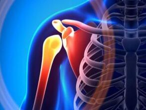 Articolazione della spalla infiammata a causa dell'artrosi – una malattia cronica del sistema muscolo-scheletrico