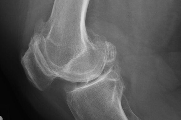Metodi per diagnosticare l'osteoartrosi del ginocchio