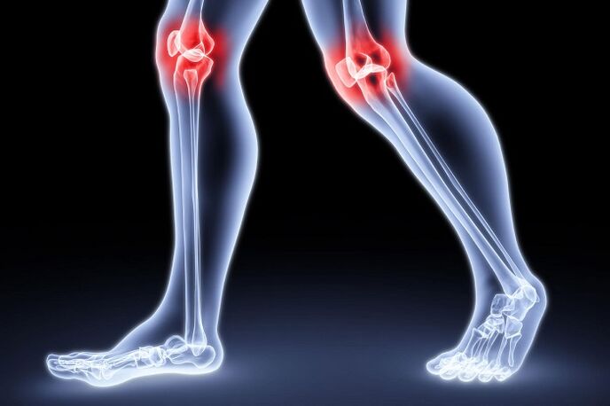 Dolore al ginocchio dovuto ad artrite e osteoartrosi