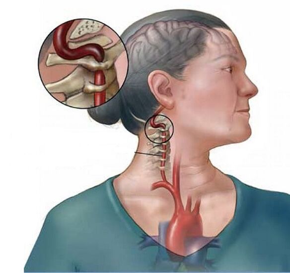 Sindrome dell'arteria vertebrale con osteocondrosi cervicale