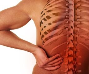 Mal di schiena con osteocondrosi lombare