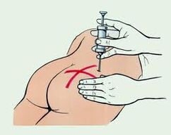 Iniezione per il trattamento dell'osteocondrosi